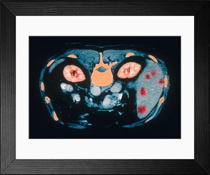 Framed Print : Liver Cancer, CT