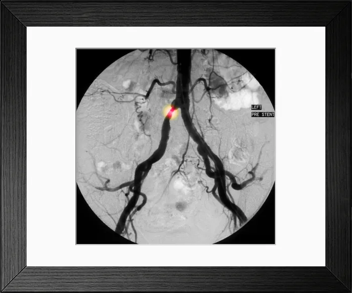 Framed Print : Stenosis in Common Iliac Artery (1 of 2) Framed Print : Stenosis in Common Iliac Artery (1 of 2)