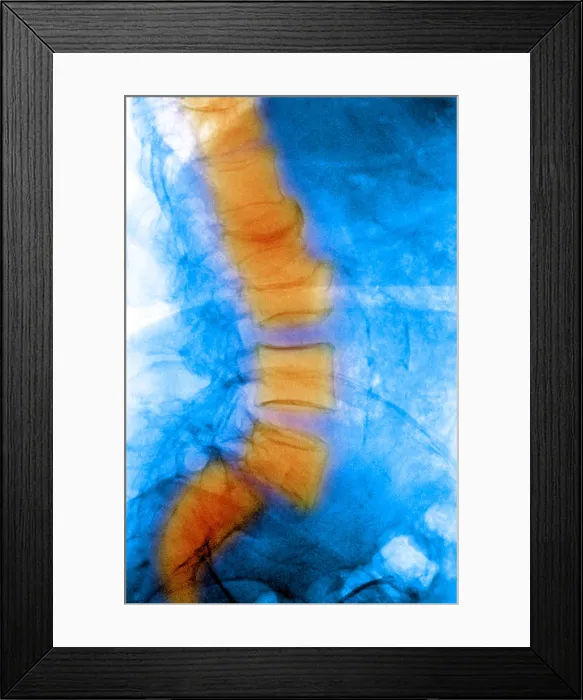 Framed Print : Spondylolisthesis Framed Print : Spondylolisthesis