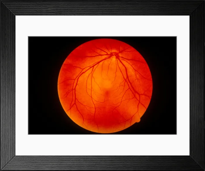 Framed Print : Retina. Fundus camera image of the human retina Framed Print : Retina. Fundus camera image of the human retina