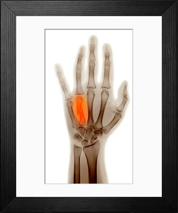 Framed Print : Fractured Metacarpal Framed Print : Fractured Metacarpal