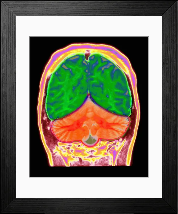 Framed Print : Cerebral MRI Framed Print : Cerebral MRI