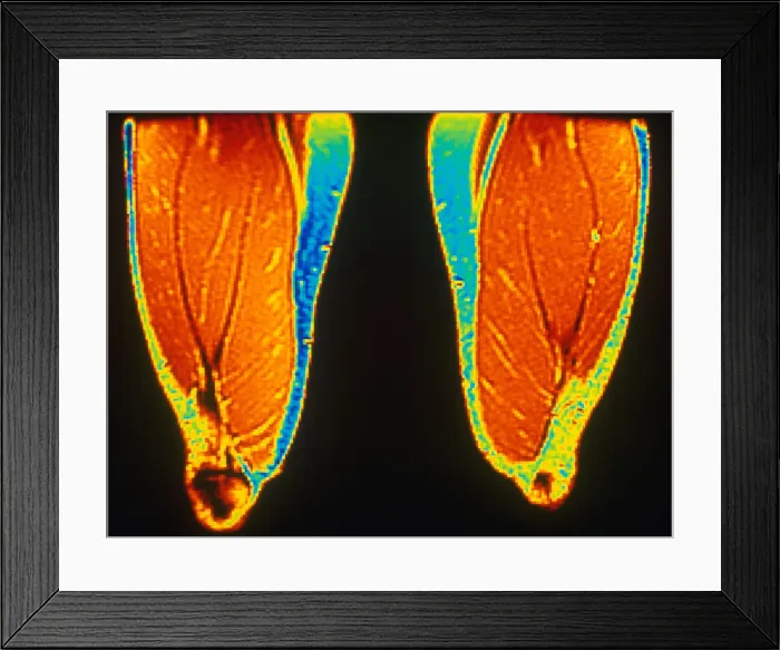 Framed Print : MRI of Upper Thighs Framed Print : MRI of Upper Thighs