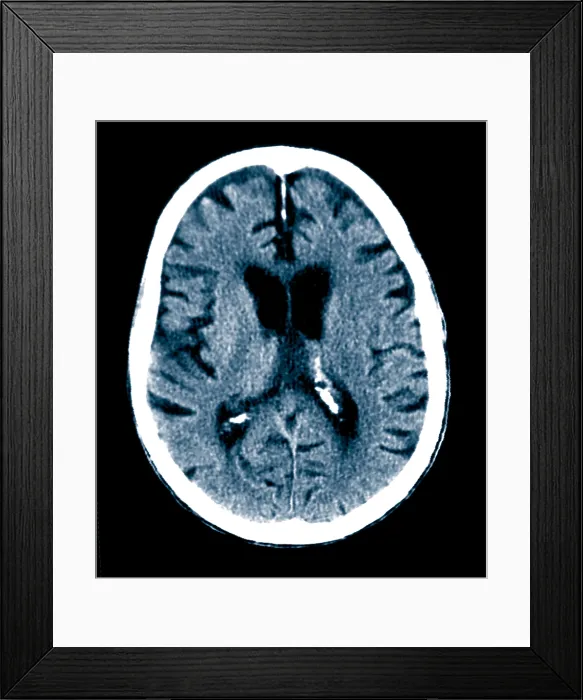 Framed Print : Brain of Alzheimer's Patient, CT Scan Framed Print : Brain of Alzheimer's Patient, CT Scan