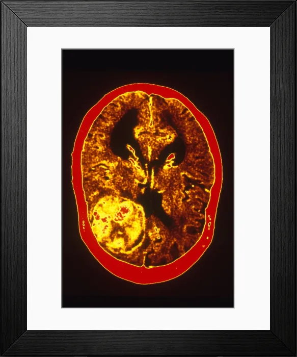 Framed Print : Brain Cancer, CT Scan Framed Print : Brain Cancer, CT Scan