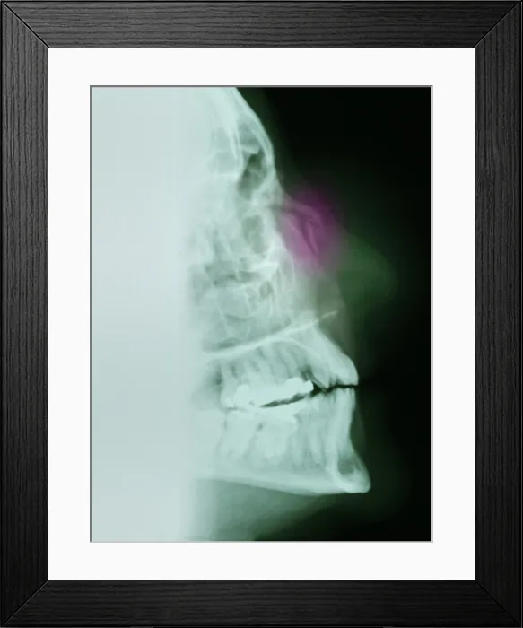 Framed Print : Nose Fracture Framed Print : Nose Fracture