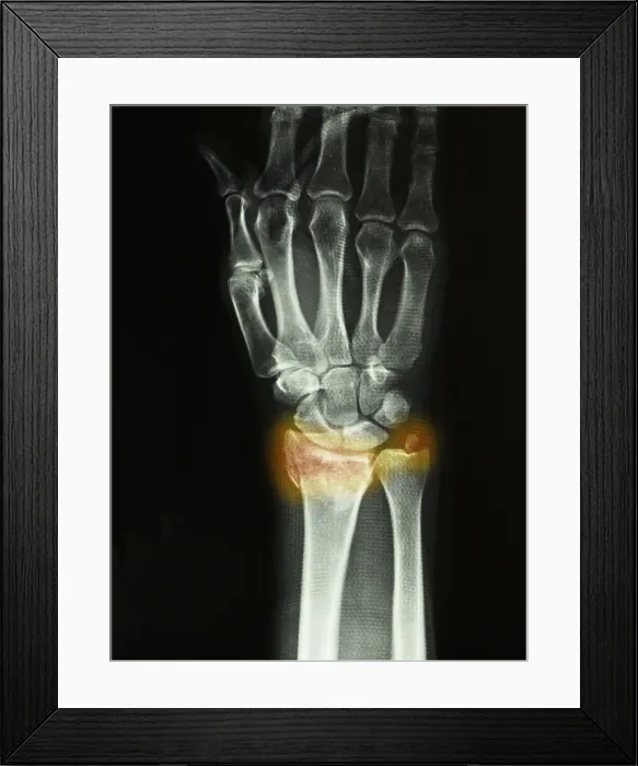 Framed Print : Colles Fracture Framed Print : Colles Fracture