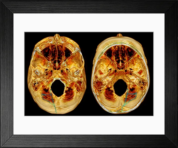 Framed Print : 3D CT Reconstruction of Skull Fracture