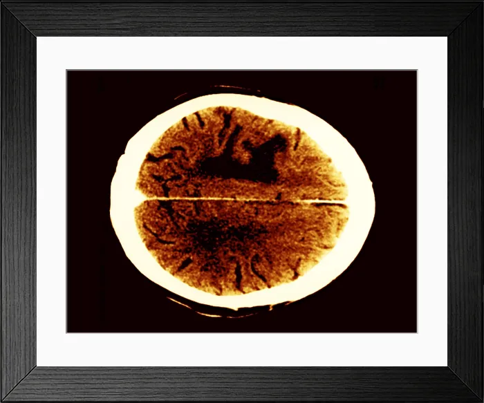 Framed Print : Brain edema Framed Print : Brain edema