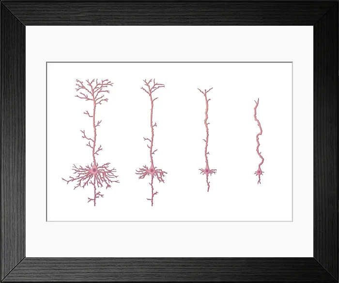 Framed Print : Alzheimer's Disease, Neuron Degeneration Framed Print : Alzheimer's Disease, Neuron Degeneration