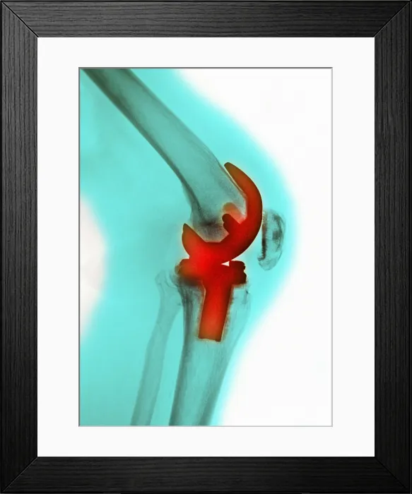 Framed Print : Knee Replacement, X-ray Framed Print : Knee Replacement, X-ray