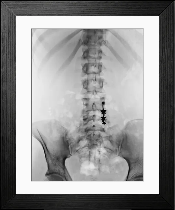Framed Print : Pierced Navel, X-ray