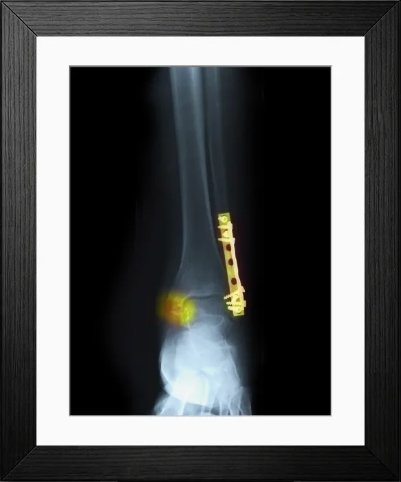 Framed Print : Fractured Ankle With Screws and Plates Framed Print : Fractured Ankle With Screws and Plates