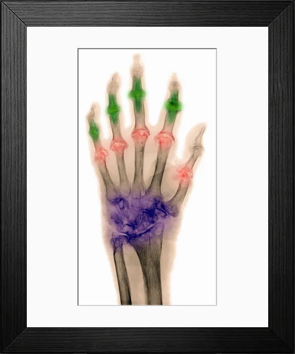 Framed Print : Arthritis. The hand of a 90 year old female with rheumatoid arthritis, osteoarthritis, Framed Print : Arthritis. The hand of a 90 year old female with rheumatoid arthritis, osteoarthritis,