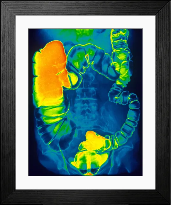 Framed Print : Large and Small Intestine, Barium X-ray