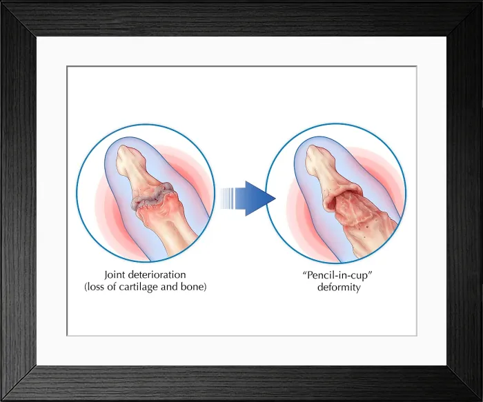 Framed Print : Psoriatic Arthritis, Joint Damage Comparison, autoimmune disease, skin condition