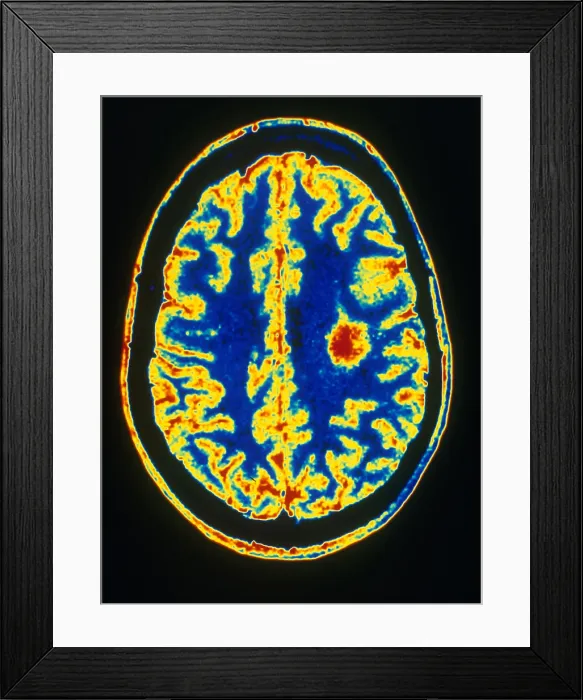 Framed Print : Glioma Framed Print : Glioma