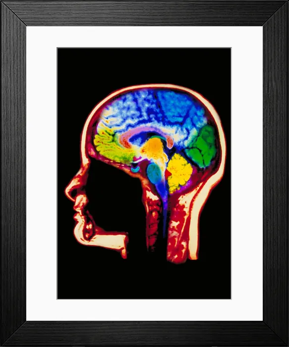 Framed Print : MRI brain scan Framed Print : MRI brain scan