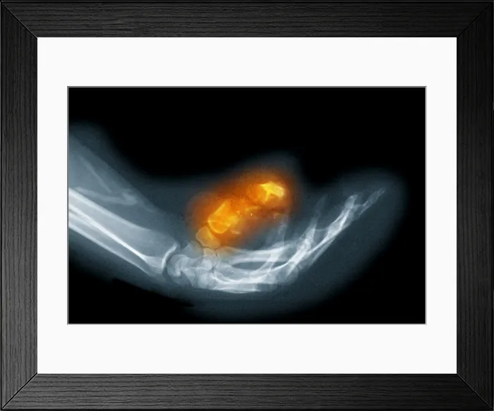 Framed Print : X-Ray of a Gunshot Wound to the Hand Framed Print : X-Ray of a Gunshot Wound to the Hand
