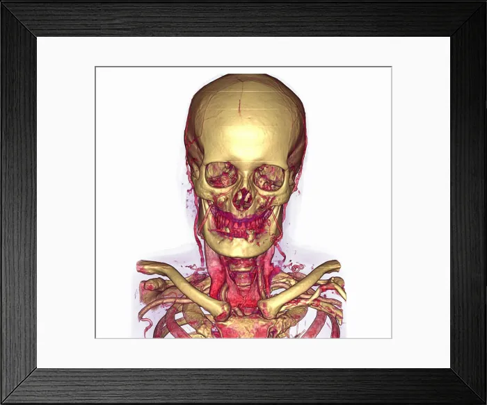 Framed Print : Male Skull & Arterial System