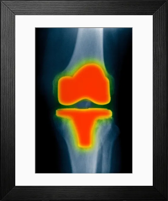 Framed Print : X-ray showing knee replacement hardware