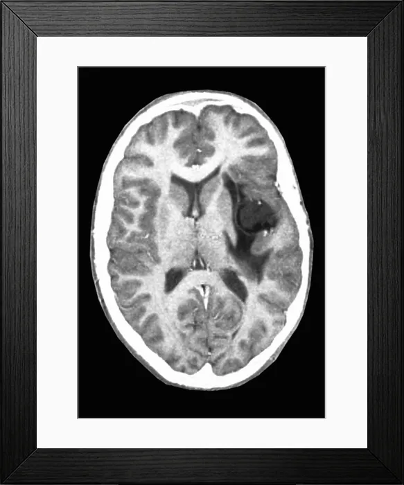 Framed Print : Glioma brain tumor