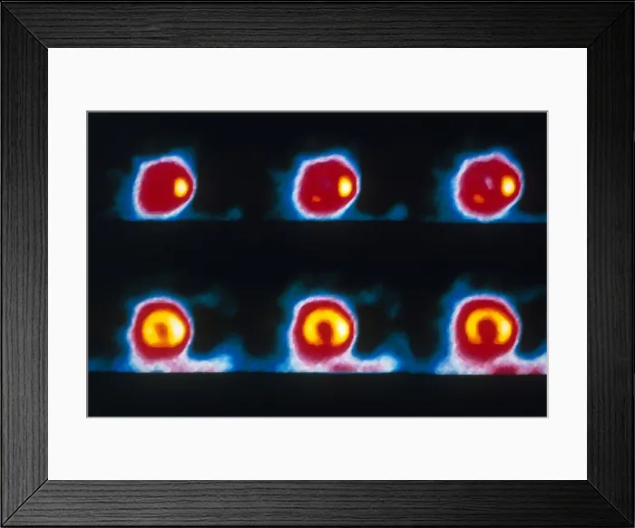 Framed Print : Coronary Heart Disease Framed Print : Coronary Heart Disease
