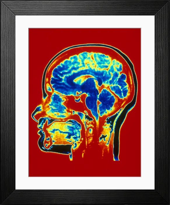 Framed Print : Brain MRI. MRI scan of normal brain Framed Print : Brain MRI. MRI scan of normal brain