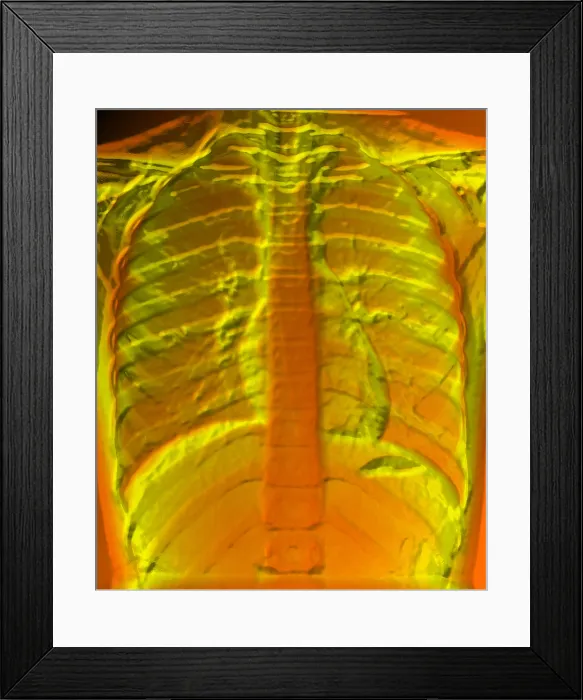 Framed Print : A normal chest X-ray Framed Print : A normal chest X-ray