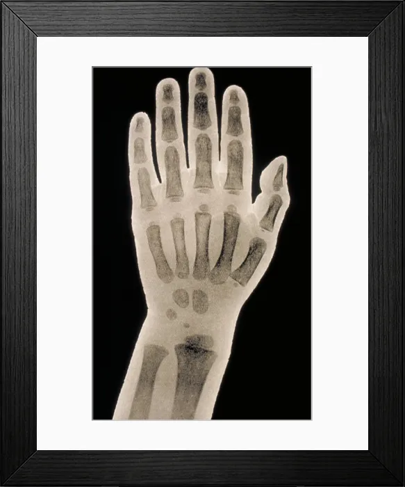 Framed Print : Hand x-ray of a 2 year old child Framed Print : Hand x-ray of a 2 year old child