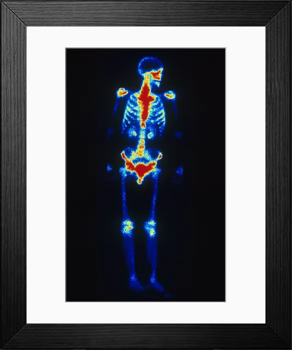 Framed Print : Normal Bone Scan