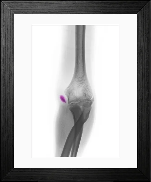 Framed Print : Little League Elbow Syndrome Framed Print : Little League Elbow Syndrome