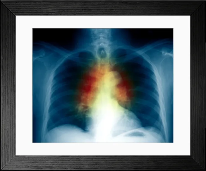 Framed Print : Sarcoidosis Framed Print : Sarcoidosis