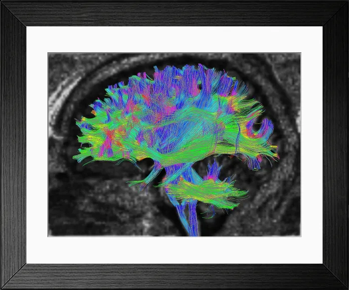 Framed Print : Normal Brain, Fiber Tractography and MRI