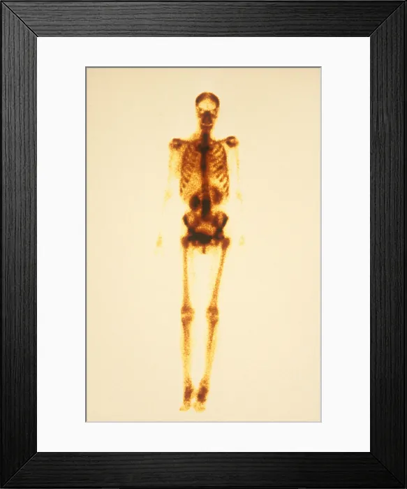 Framed Print : Normal Bone Scan Framed Print : Normal Bone Scan