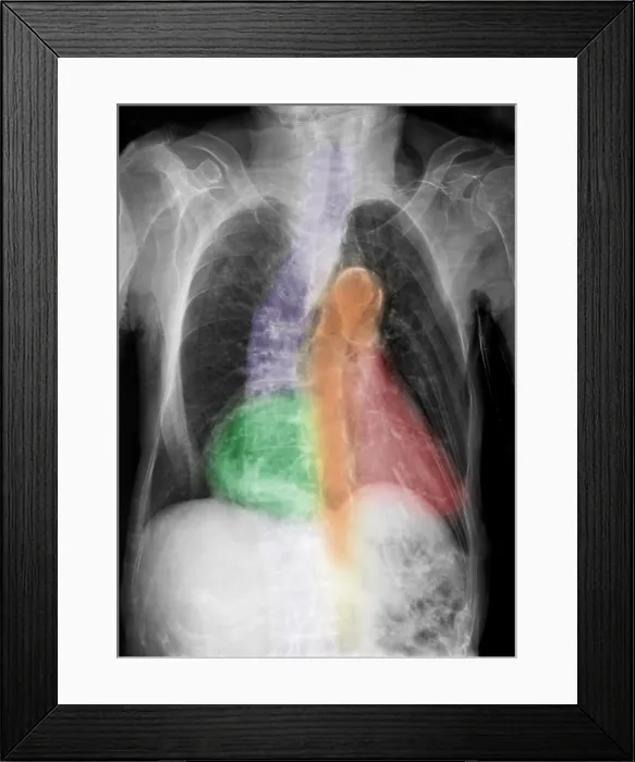 Framed Print : Calcification of Aorta, Scoliosis in 96 Year Old Woman Framed Print : Calcification of Aorta, Scoliosis in 96 Year Old Woman