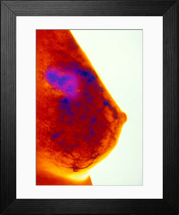 Framed Print : Mammogram indicating breast cancer. Color enhanced Framed Print : Mammogram indicating breast cancer. Color enhanced