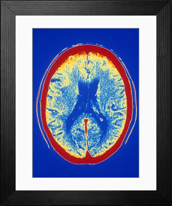 Framed Print : Brain, CT Scan Framed Print : Brain, CT Scan