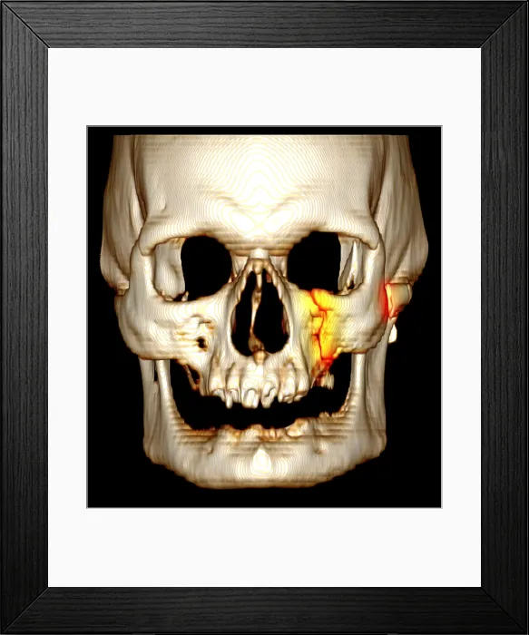 Framed Print : Facial Fractures, CT Scan