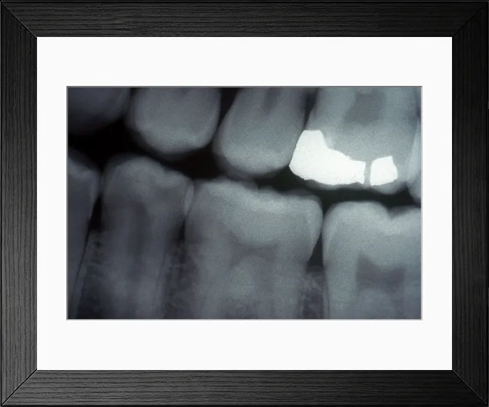 Framed Print : Tooth With Filling, X-ray
