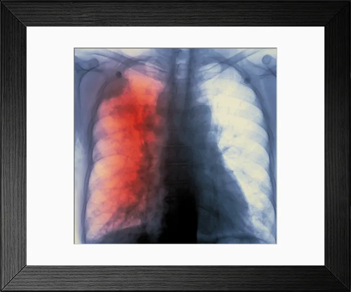 Framed Print : Lung cancer x-ray