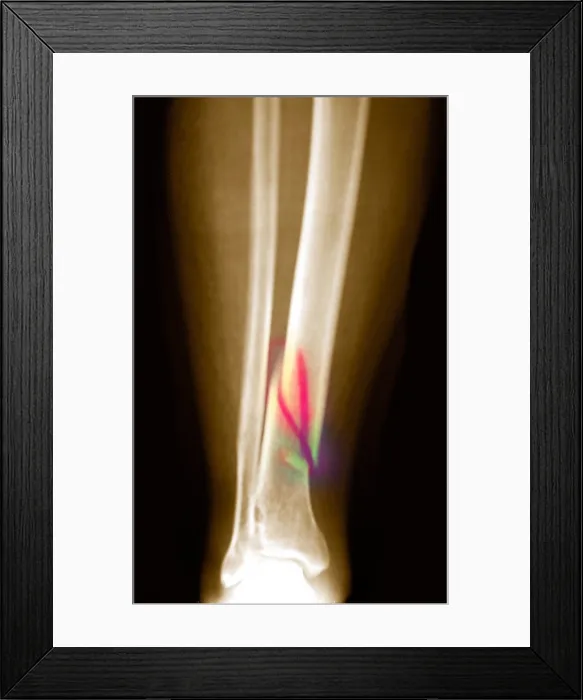 Framed Print : X-ray of fractured tibia
