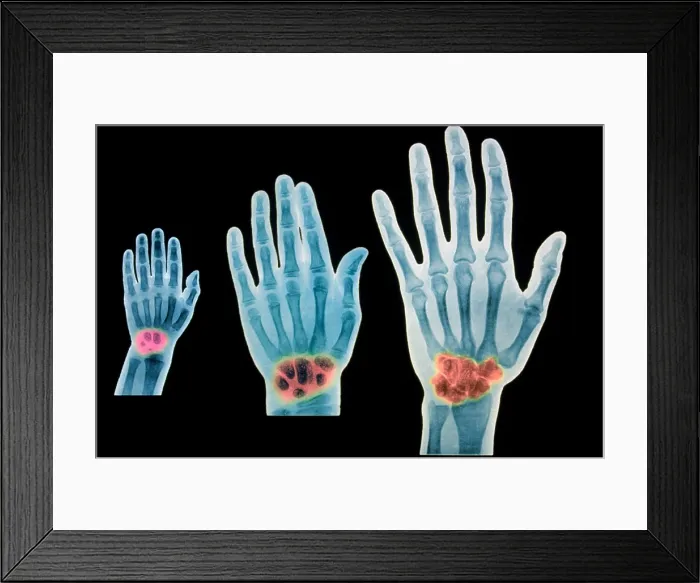 Framed Print : X-rays of 2 year old, 7 year old, and adult Framed Print : X-rays of 2 year old, 7 year old, and adult
