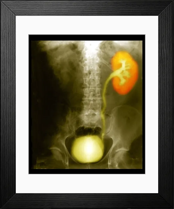 Framed Print : Renal Colic Framed Print : Renal Colic