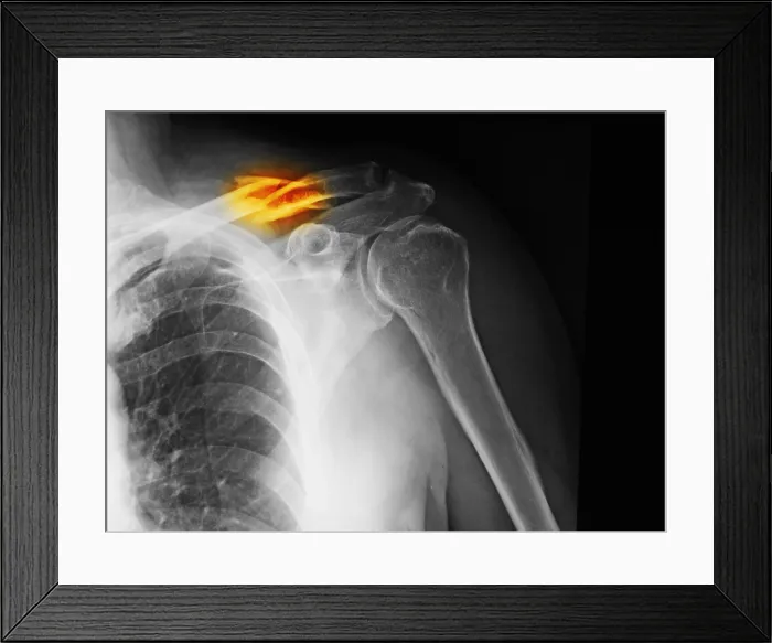 Framed Print : Clavicle Fracture Framed Print : Clavicle Fracture
