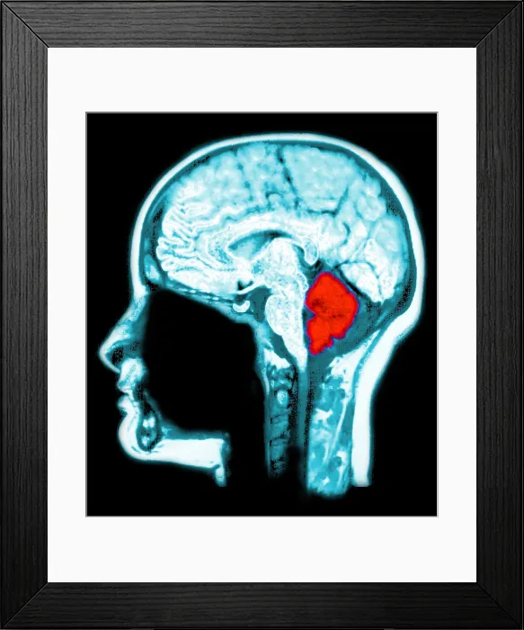 Framed Print : Location of Cerebellum, MRI