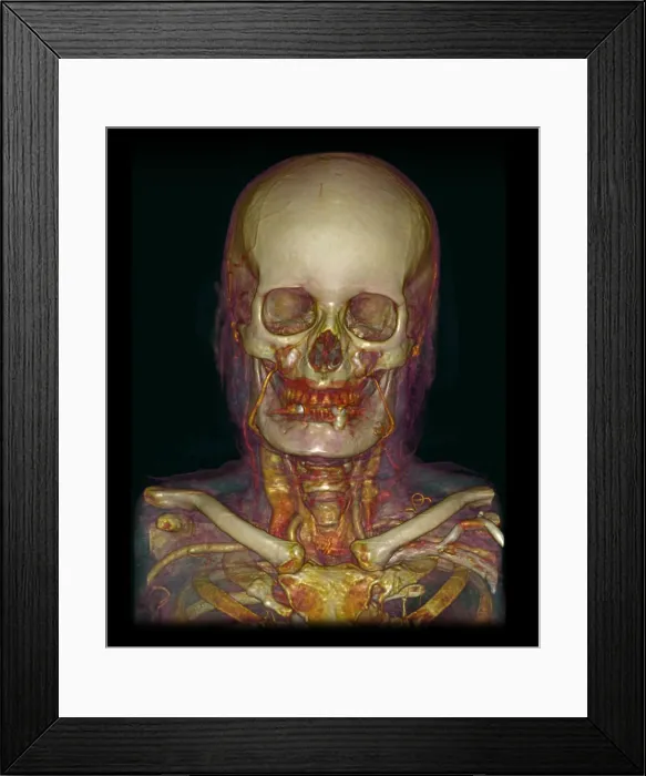 Framed Print : Male Skull & Arterial System Framed Print : Male Skull & Arterial System
