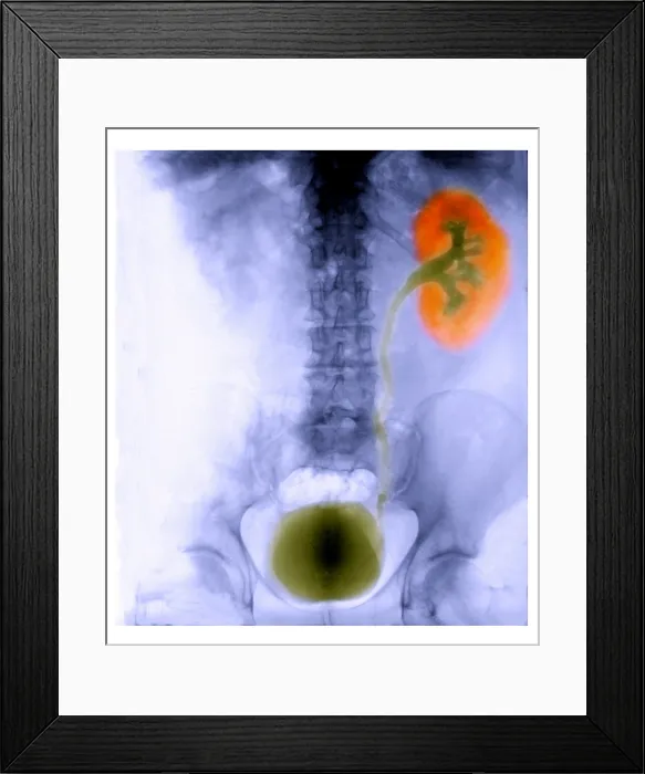 Framed Print : Renal Colic Framed Print : Renal Colic