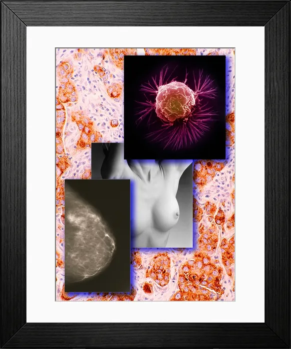 Framed Print : Breast Cancer Montage Framed Print : Breast Cancer Montage