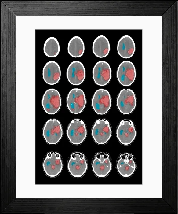 Framed Print : CT Scan of Intracranial Hemorrhage Framed Print : CT Scan of Intracranial Hemorrhage
